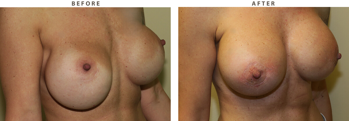 Breast revision Chicago - Before and After Pictures