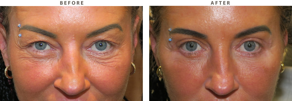 Blepharoplasty Chicago - Before and After Pictures