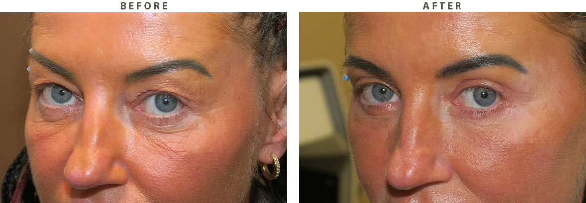 Blepharoplasty Chicago - Before and After Pictures