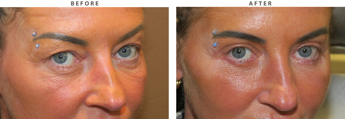 Blepharoplasty Chicago - Before and After Pictures