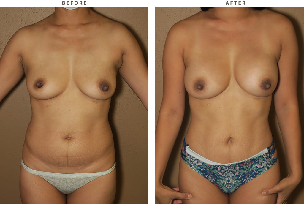 Breast augmentation Chicago - Before and After Pictures