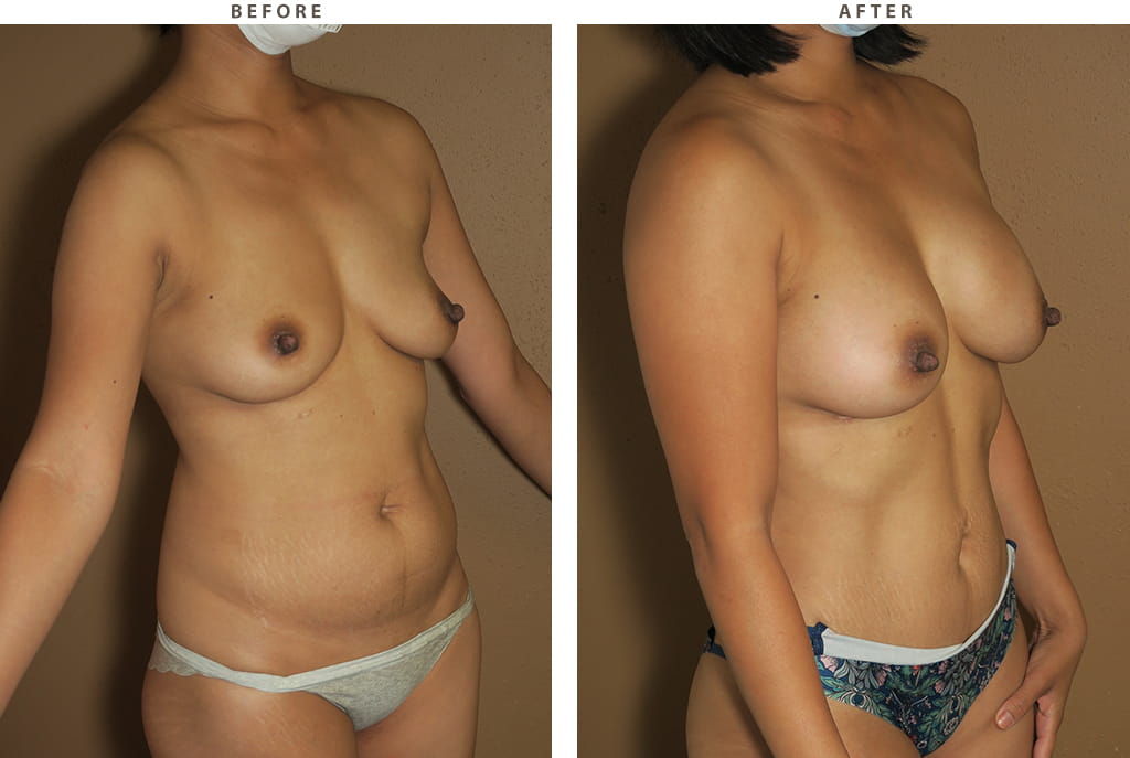 Breast augmentation Chicago - Before and After Pictures