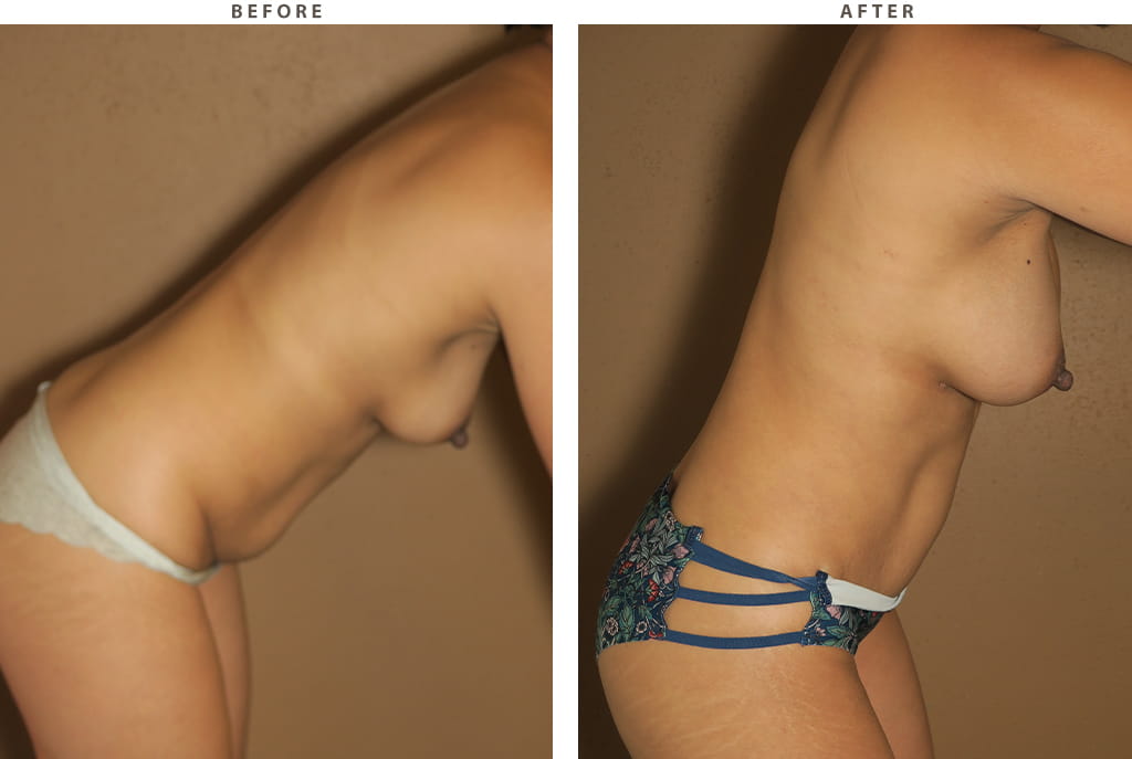 Breast augmentation Chicago - Before and After Pictures