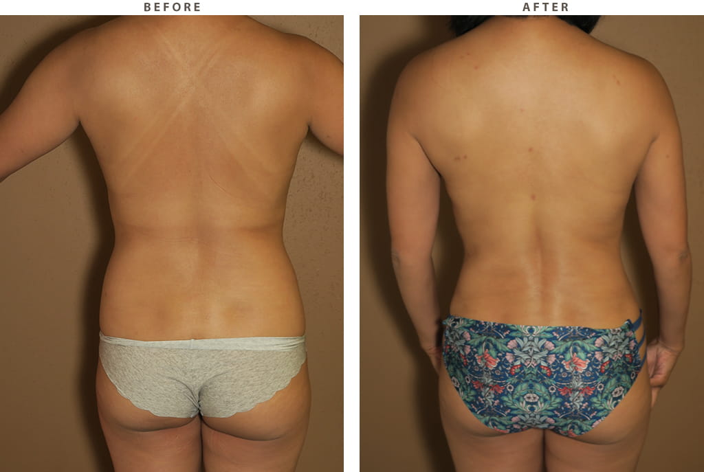 Breast augmentation Chicago - Before and After Pictures