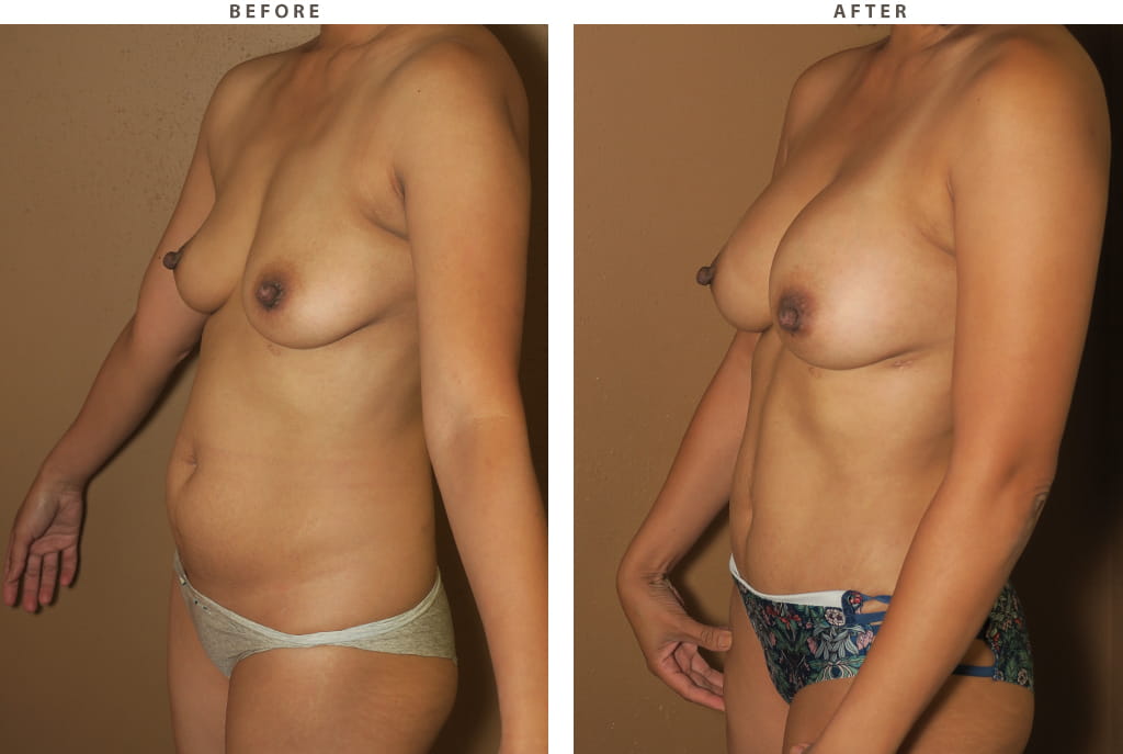 Breast augmentation Chicago - Before and After Pictures