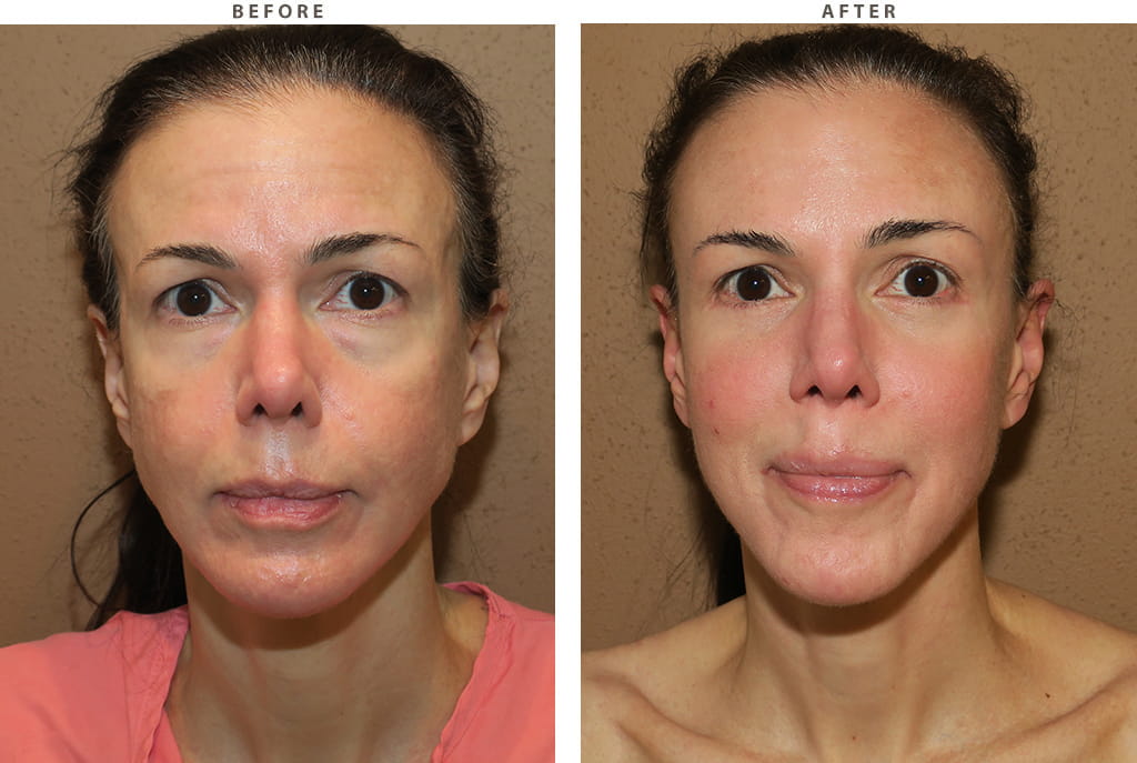 Facelift Chicago - Before and After Pictures