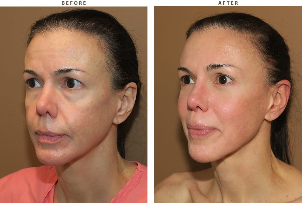 Facelift Chicago - Before and After Pictures
