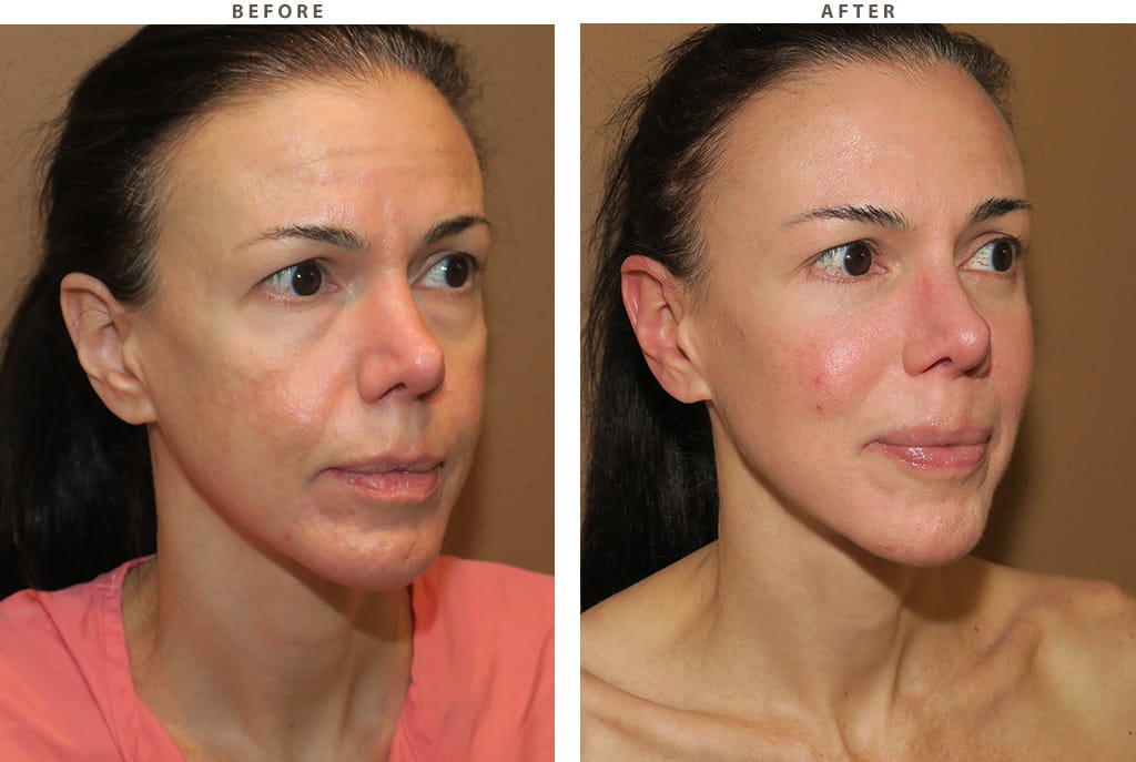Facelift Chicago - Before and After Pictures
