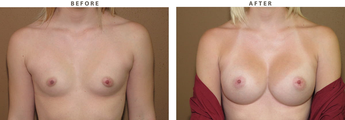 Breast augmentation Chicago - Before and After Pictures