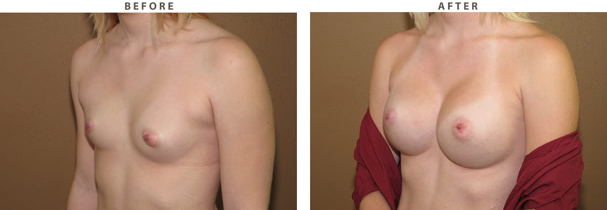 Breast augmentation Chicago - Before and After Pictures