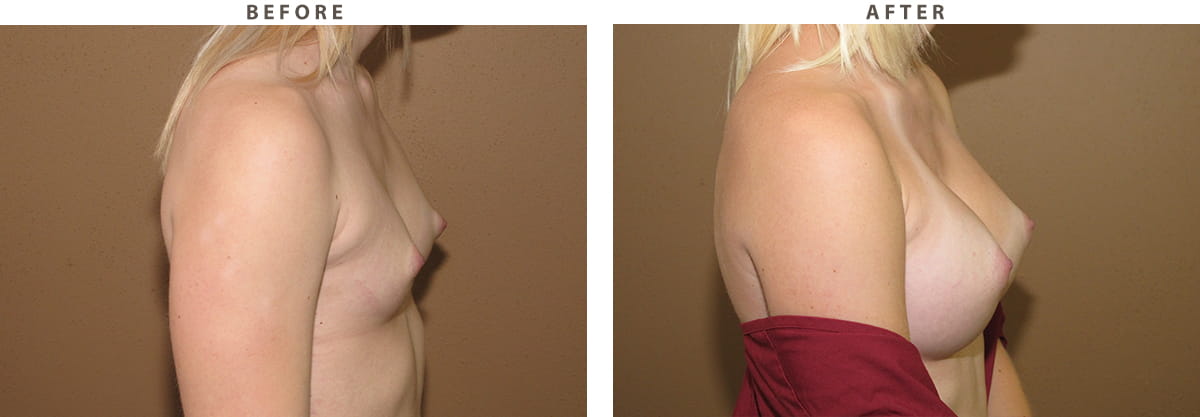 Breast augmentation Chicago - Before and After Pictures