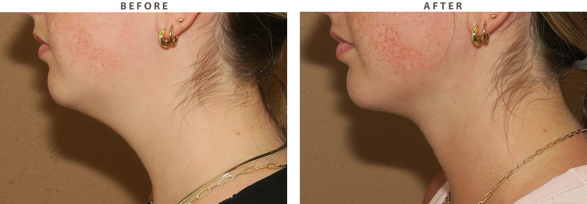 Neck liposuction Chicago - Before and After Pictures