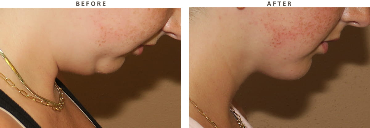 Neck liposuction Chicago - Before and After Pictures