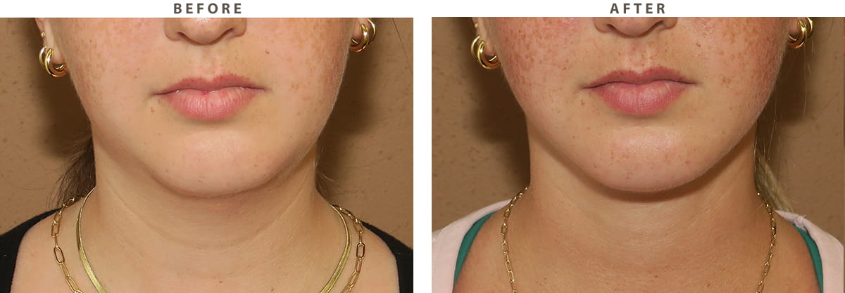 Neck liposuction Chicago - Before and After Pictures