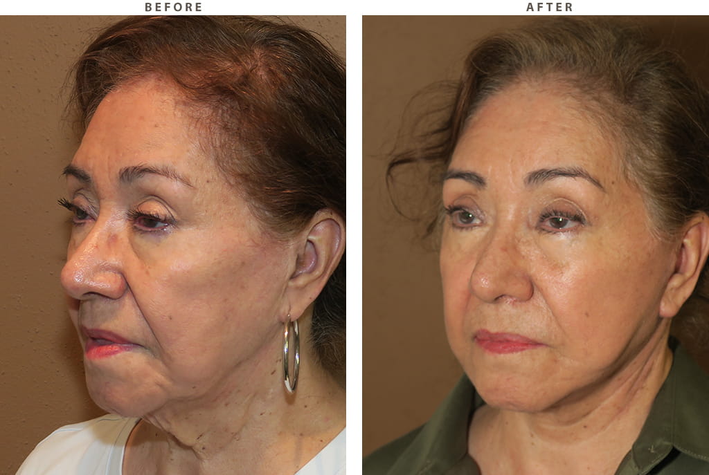 Facelift Chicago - Before and After Pictures