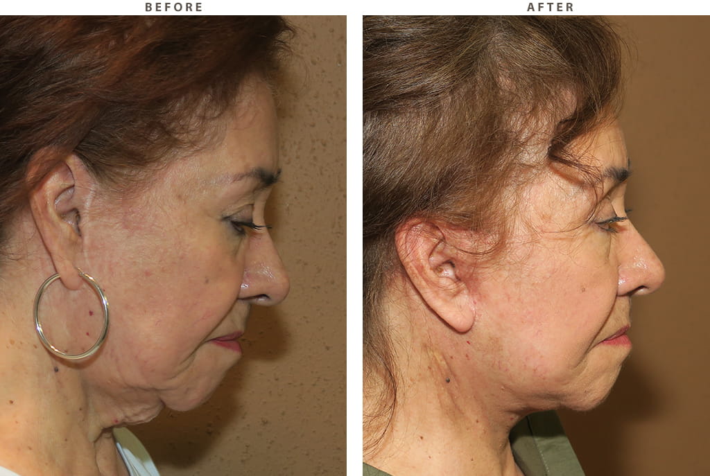 Facelift Chicago - Before and After Pictures