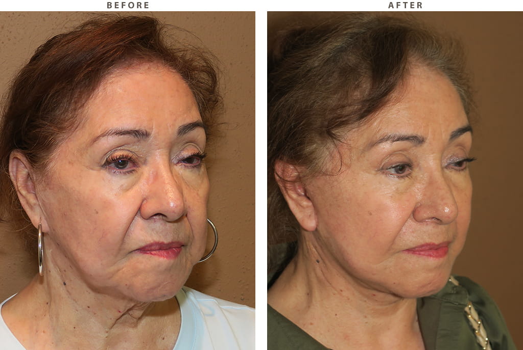 Facelift Chicago - Before and After Pictures