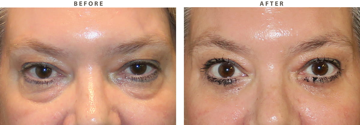 Blepharoplasty Chicago - Before and After Pictures