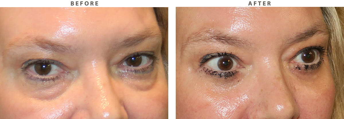 Blepharoplasty Chicago - Before and After Pictures