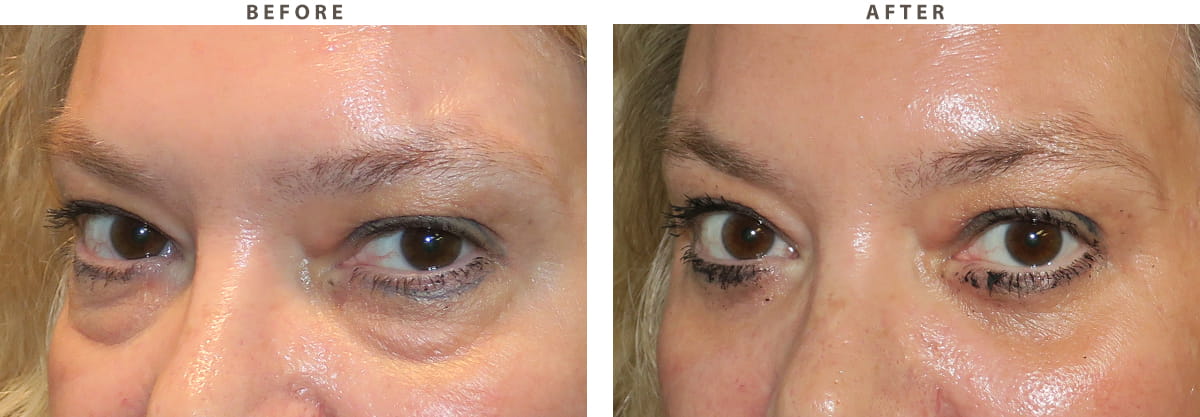 Blepharoplasty Chicago - Before and After Pictures