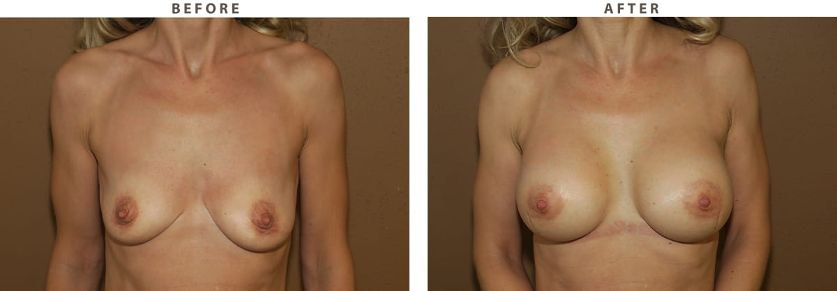Breast augmentation Chicago - Before and After Pictures