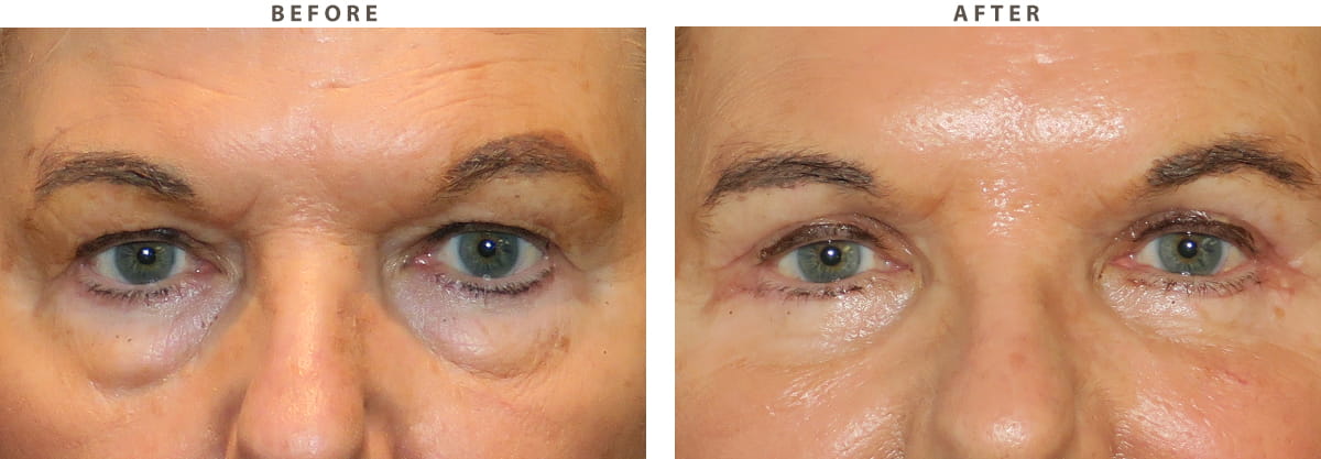 Blepharoplasty Chicago - Before and After Pictures