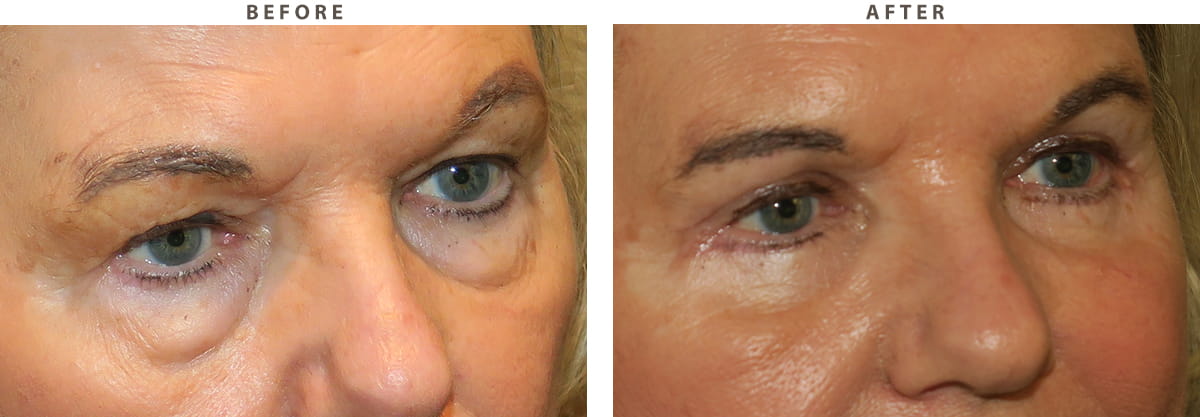 Blepharoplasty Chicago - Before and After Pictures