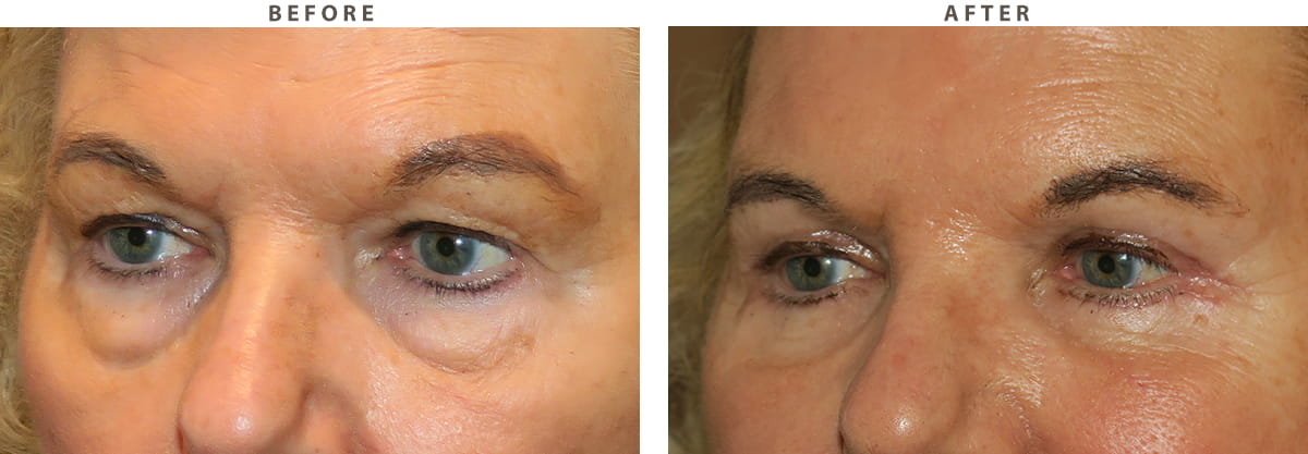 Blepharoplasty Chicago - Before and After Pictures
