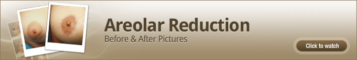 Areolar Reduction - Before and After Pictures