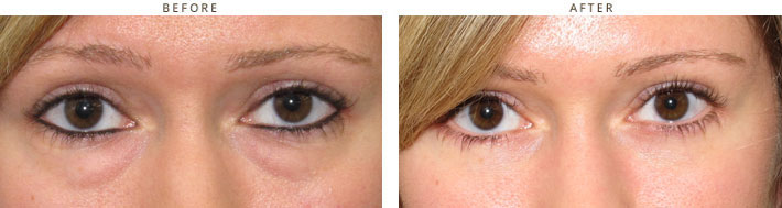 Eyelid lift surgery (blepharoplasty) - Before and After Pictures