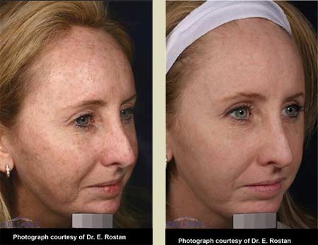 Fraxel laser treatment before & after pictures