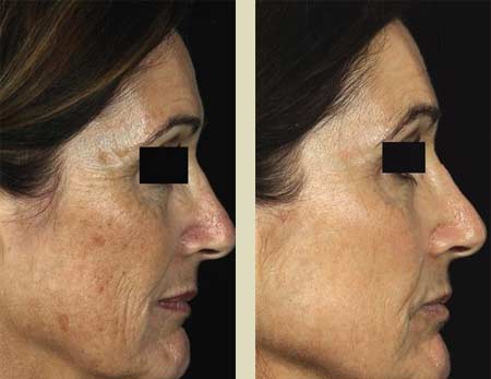 Fraxel laser treatment before & after pictures