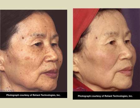 Fraxel laser treatment before & after pictures