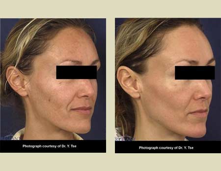 Fraxel laser treatment before & after pictures