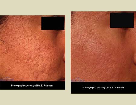 Fraxel laser treatment before & after pictures