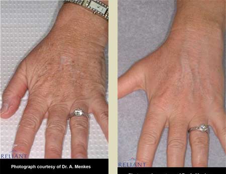 Fraxel laser treatment before & after pictures