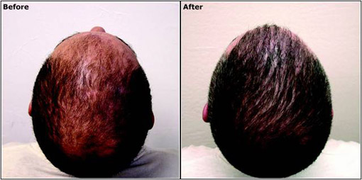 Hair Transplanatation Hair Transplanatation