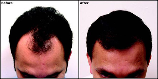 Hair Transplanatation Hair Transplanatation