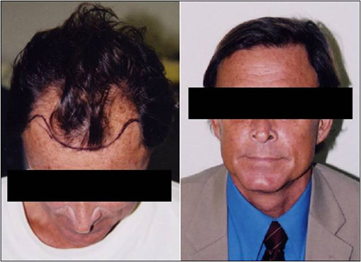 Hair Transplanatation Hair Transplanatation