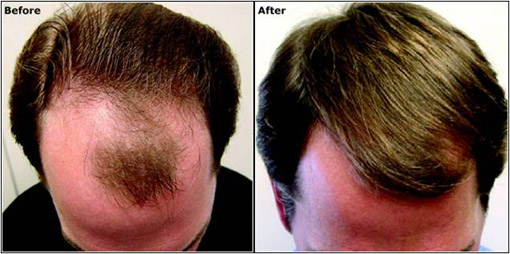 Hair Transplanatation Hair Transplanatation