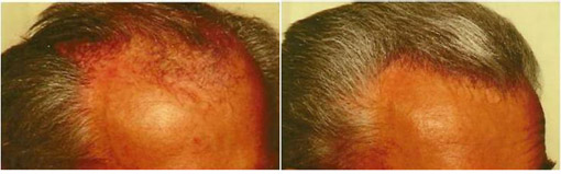 Hair Transplanatation Hair Transplanatation