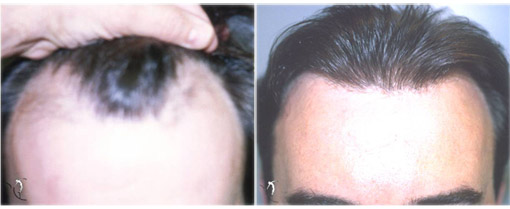 Hair Transplanatation Hair Transplanatation
