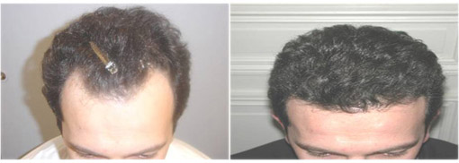 Hair Transplanatation Hair Transplanatation