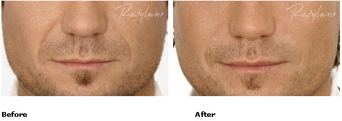 Restylane - Nasolabial Folds - Before & After Pictures