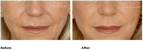 Restylane - Nasolabial Folds - Before & After Pictures