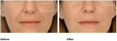 Restylane - Nasolabial Folds - Before & After Pictures