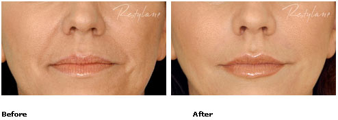 Restylane - Nasolabial Folds - Before & After Pictures