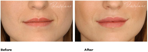 Restylane - Lips - Before & After Pictures