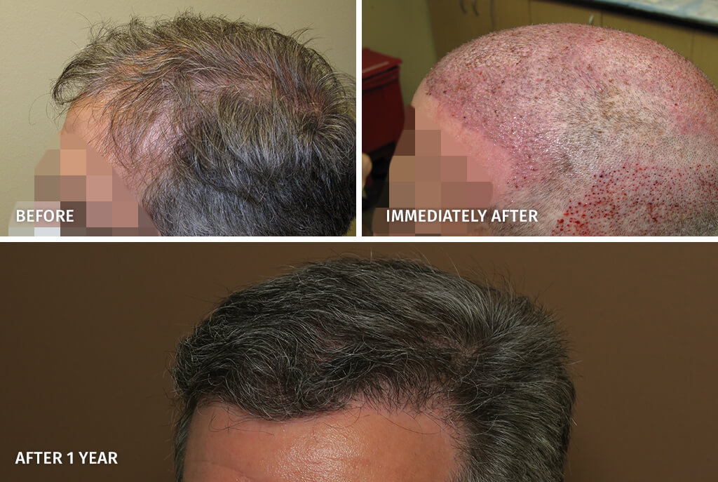 Hair Transplant - Before and After Pictures