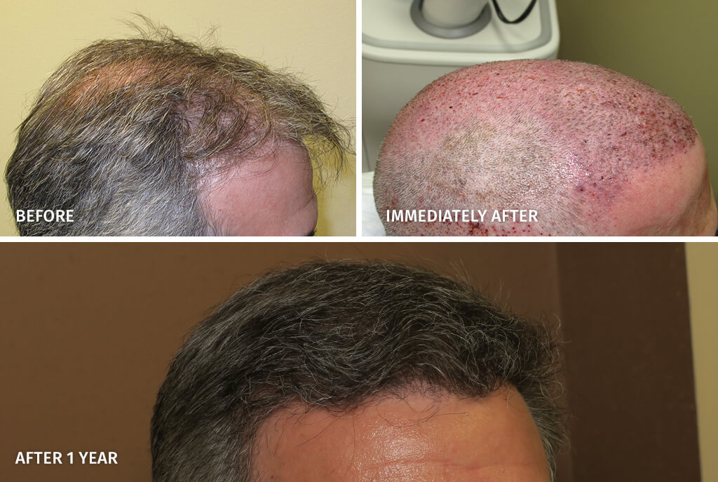 Hair Transplant - Before and After Pictures
